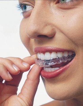 invisalign-brace