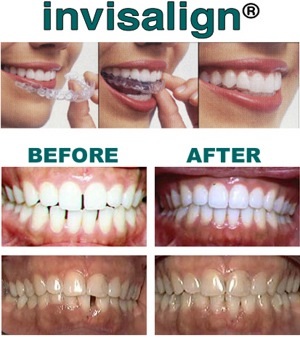 invisalign-dentist-manchester1