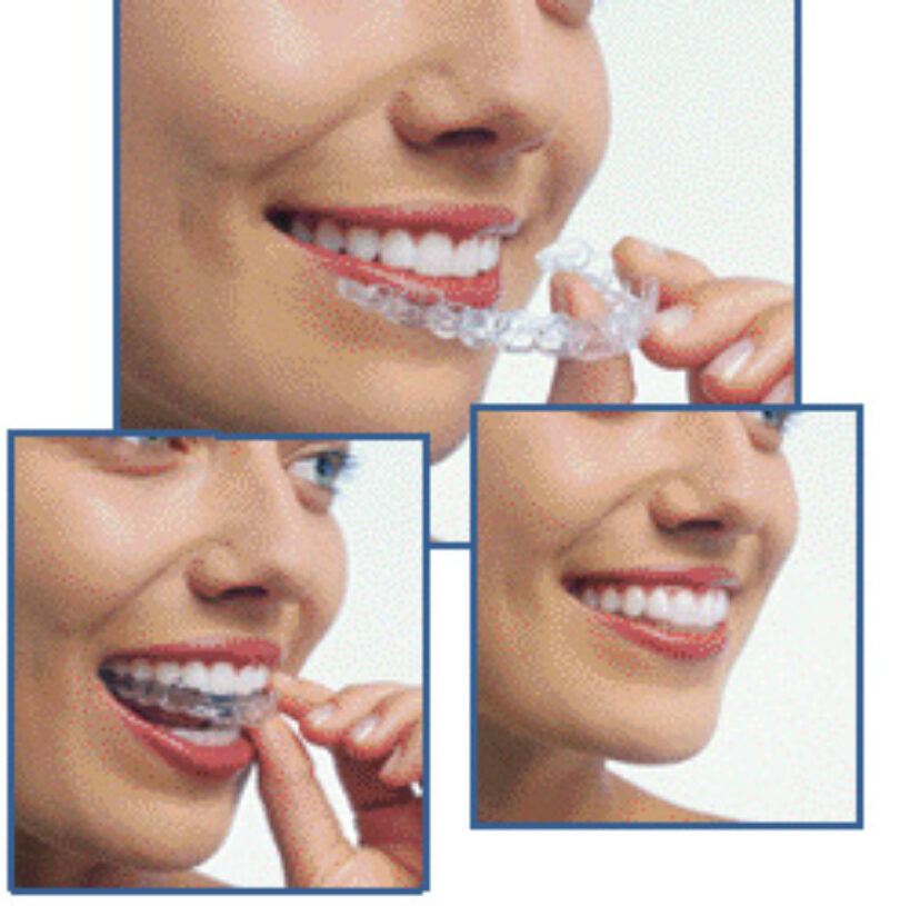 Clear aligners are clear and removable.