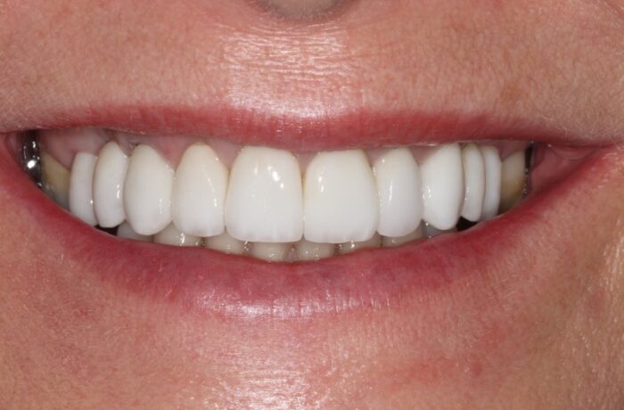 post-op_800x533 (1) After - Cheadle Hulme Dental