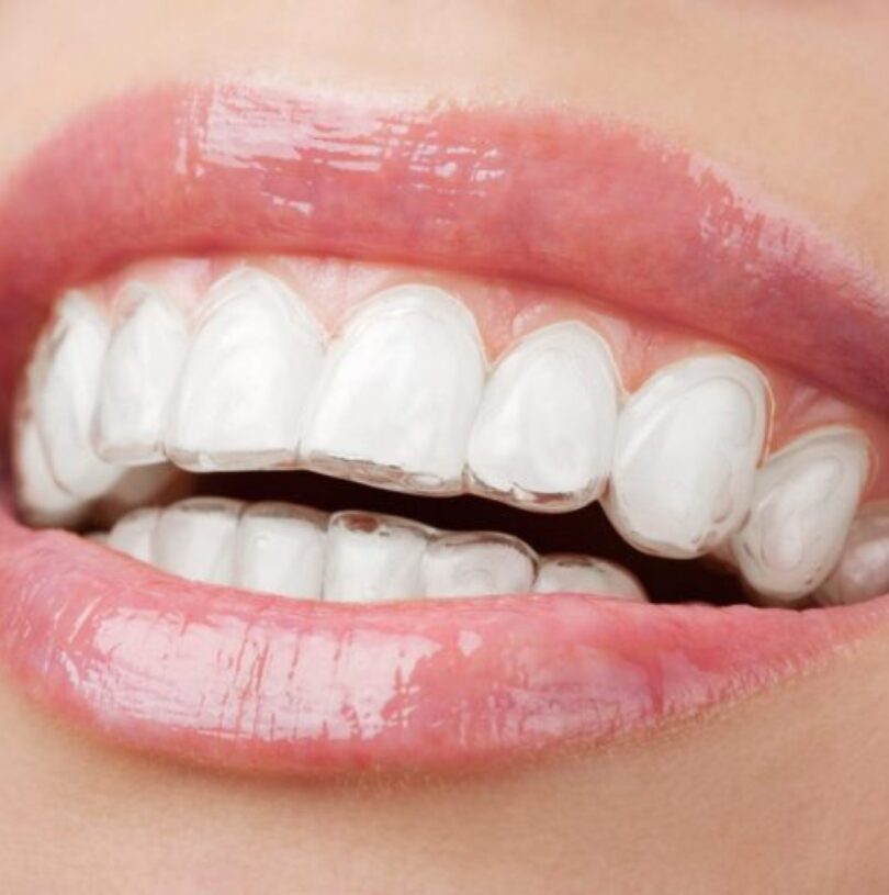 blog - Cheadle Hulme Dental