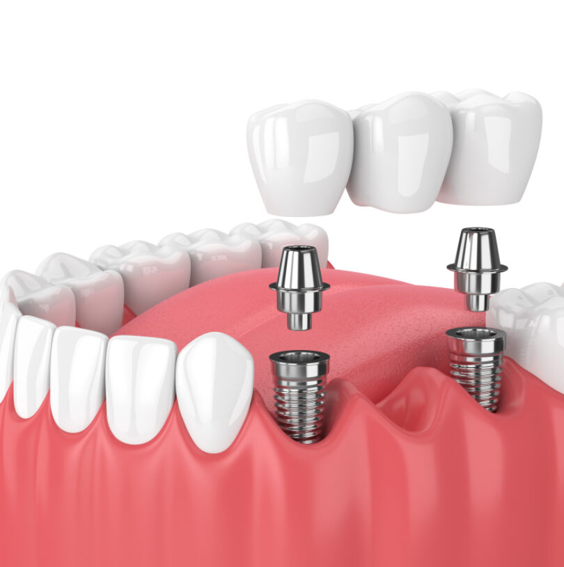 Dental Implants in Manchester vs A Dental Bridge