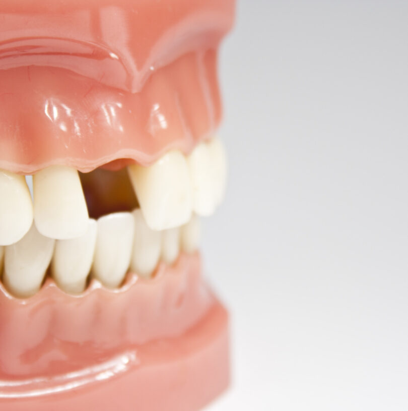 Dental Implants Manchester