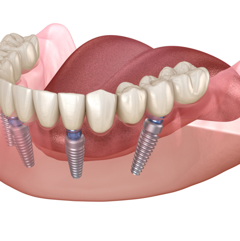 blog - Cheadle Hulme Dental