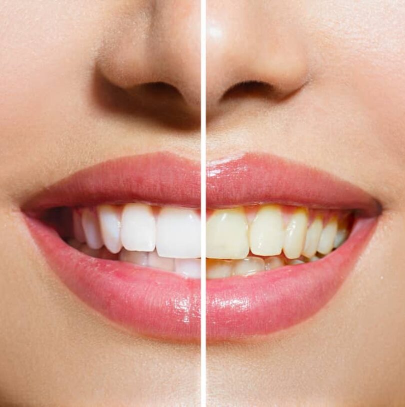 Teeth Whitening Alderley Edge