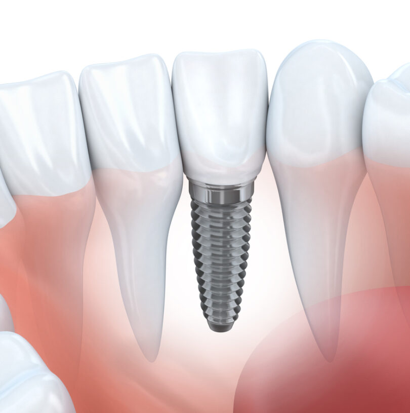 Dental Implants Manchester