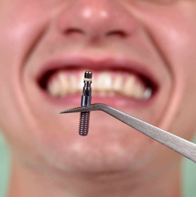 blog - Cheadle Hulme Dental