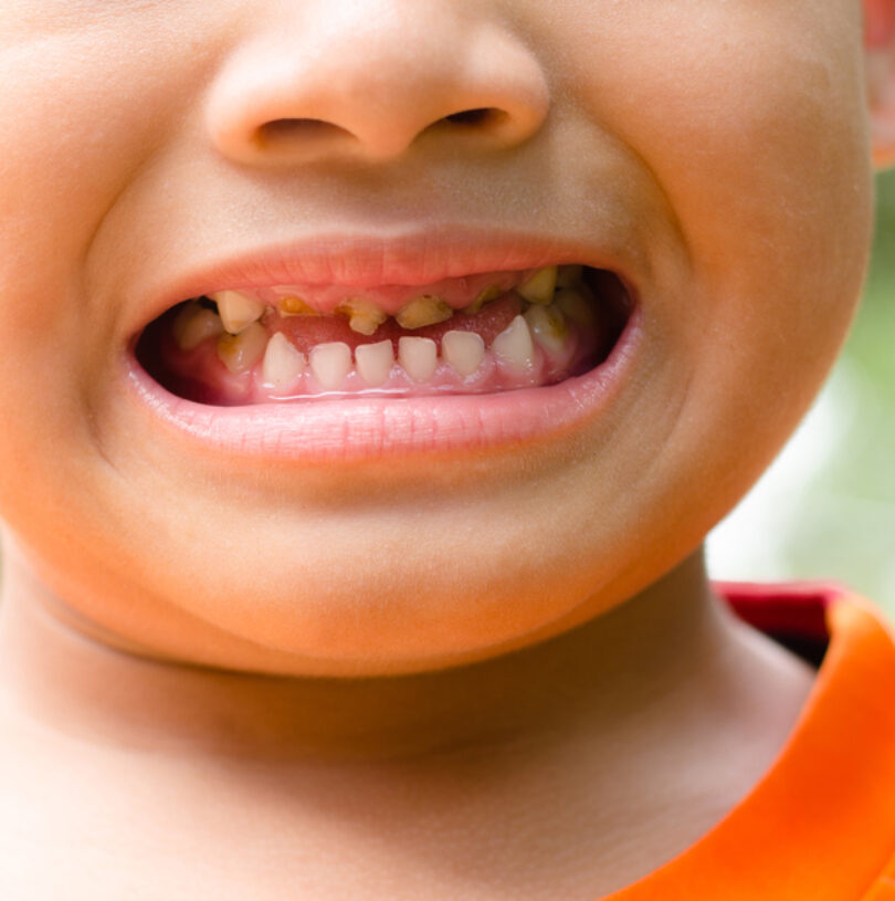 Tooth Decay Treatment