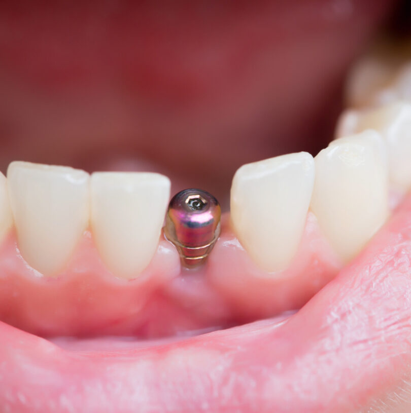 Dental Implants Manchester
