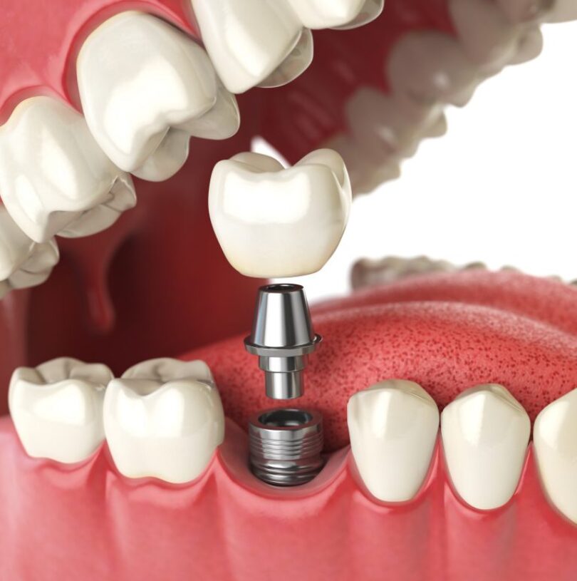 blog - Cheadle Hulme Dental