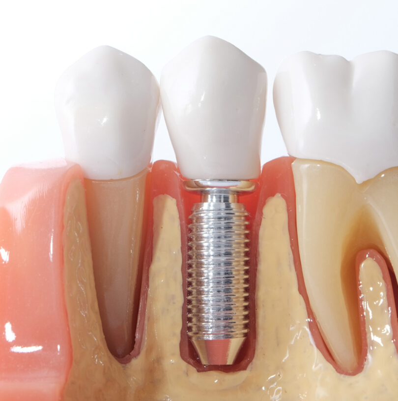 Dental Bridges in Manchester