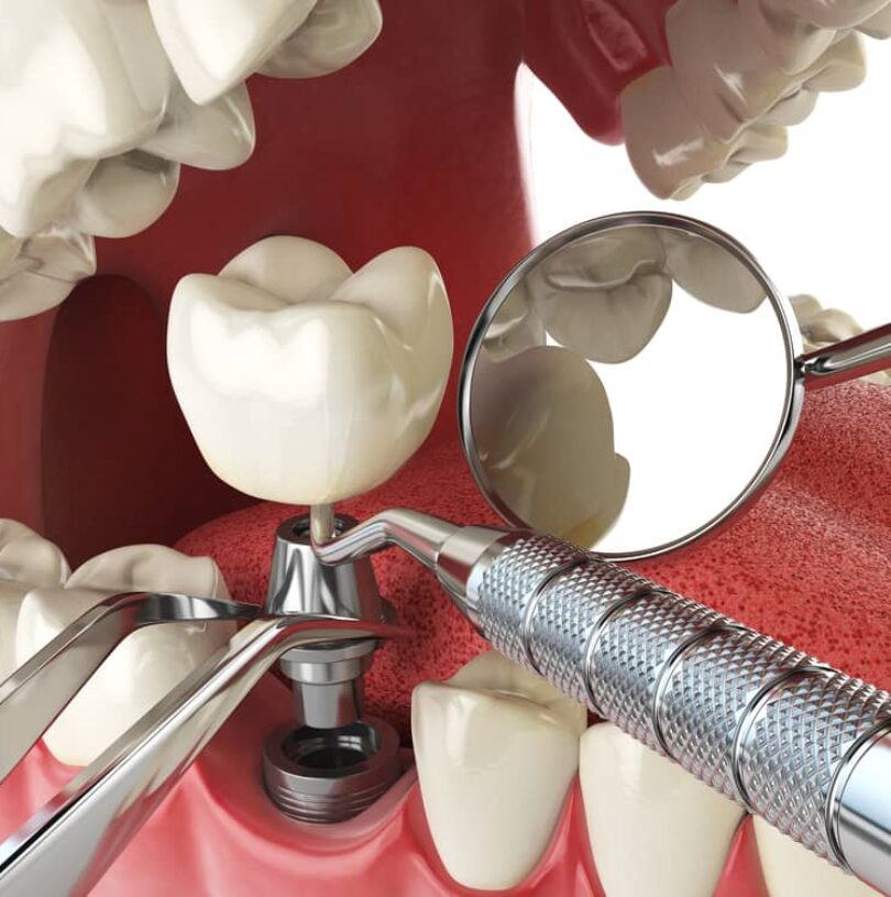 blog - Cheadle Hulme Dental