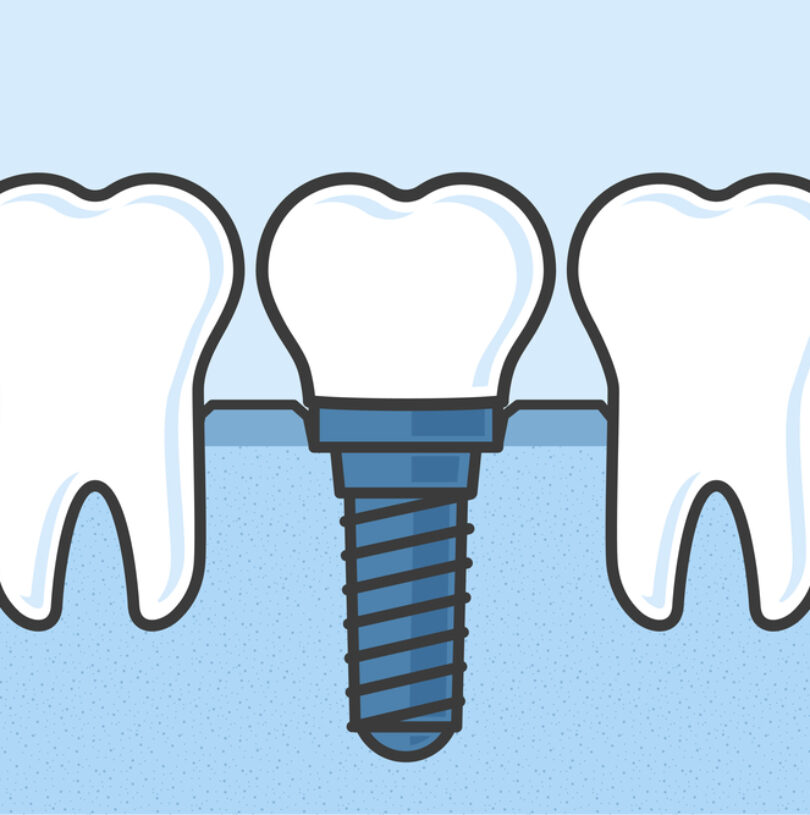 blog - Cheadle Hulme Dental