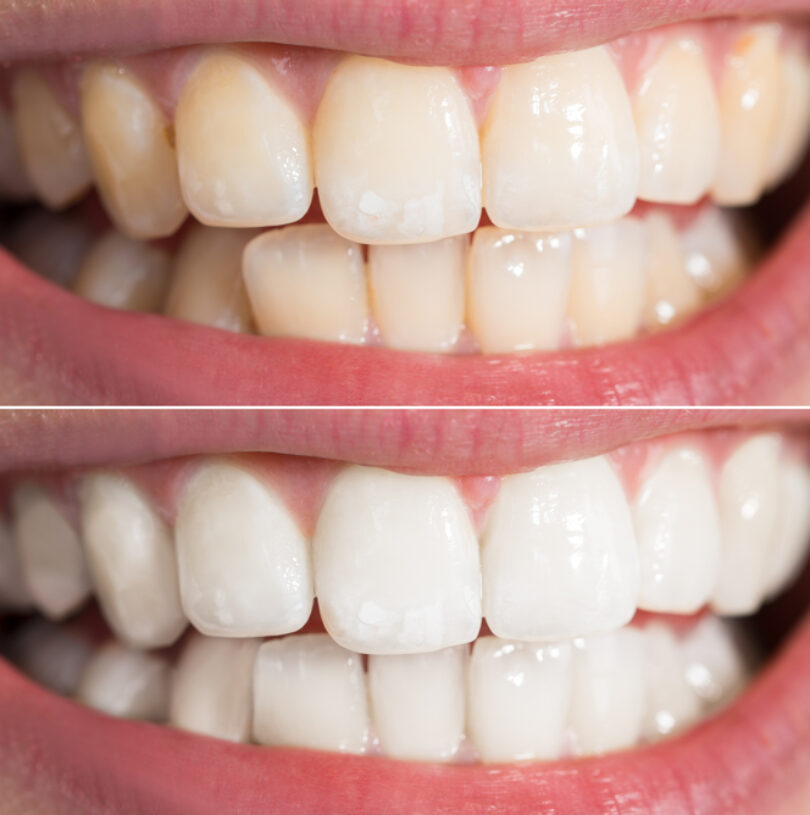 Dental Implants Manchester