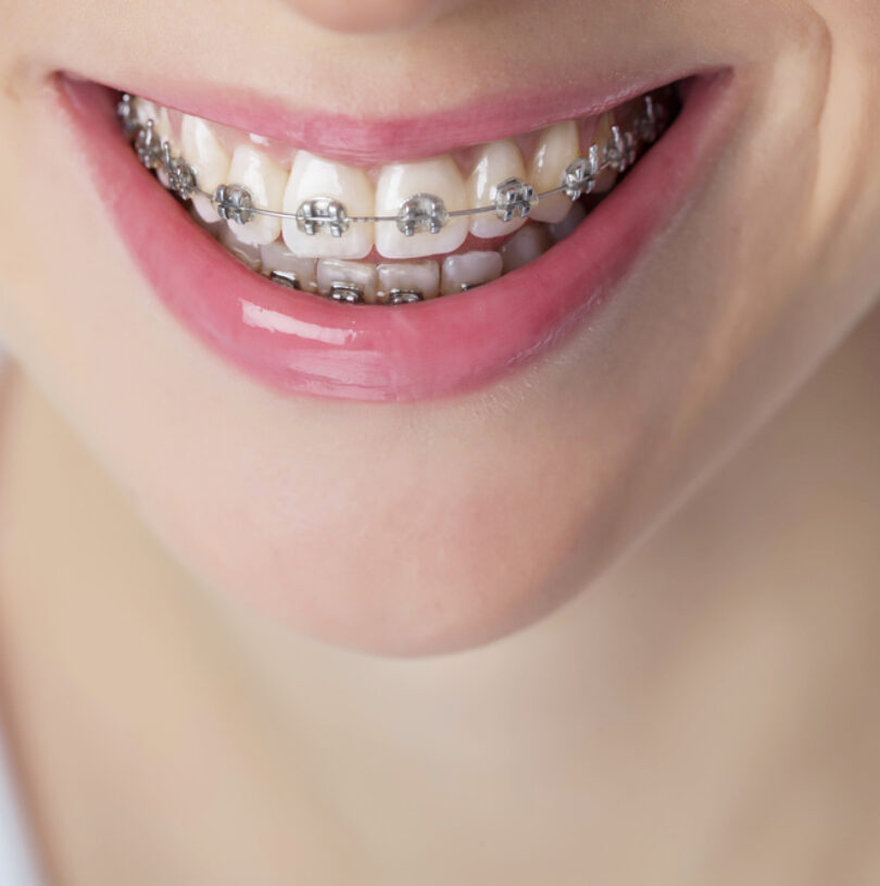 Braces Offers for Adults