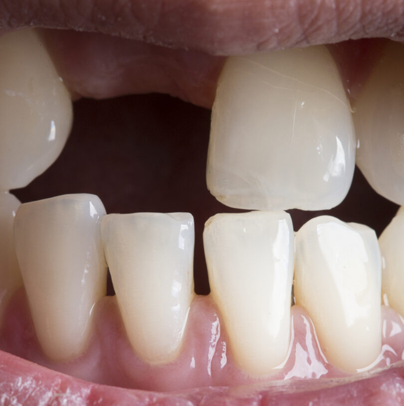 Dental Implants in Manchester