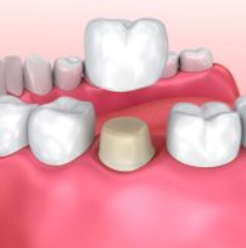 blog - Cheadle Hulme Dental