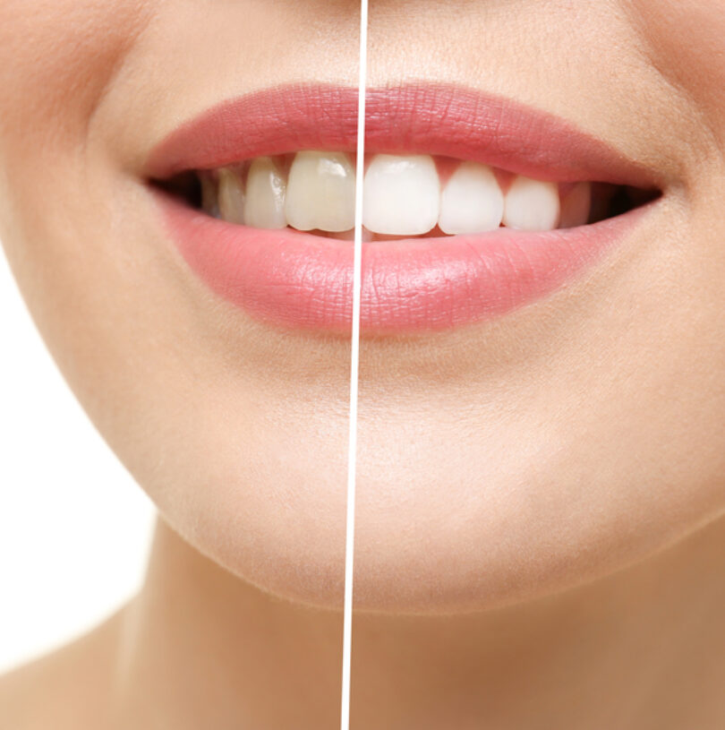 Teeth Whitening Poynton
