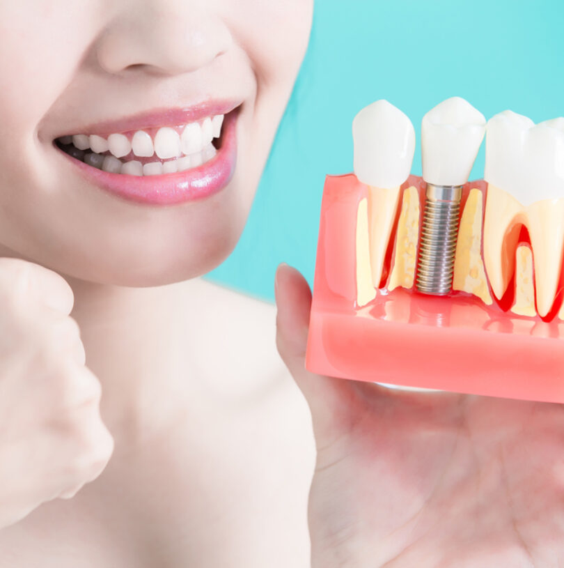 Dental Implants Manchester