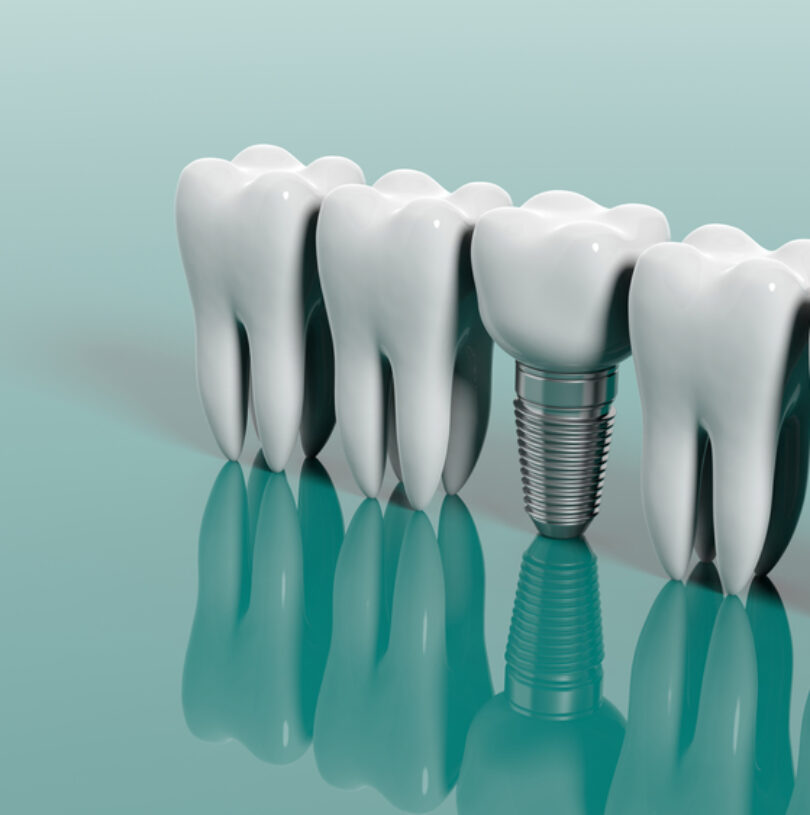 Dental Implants Manchester
