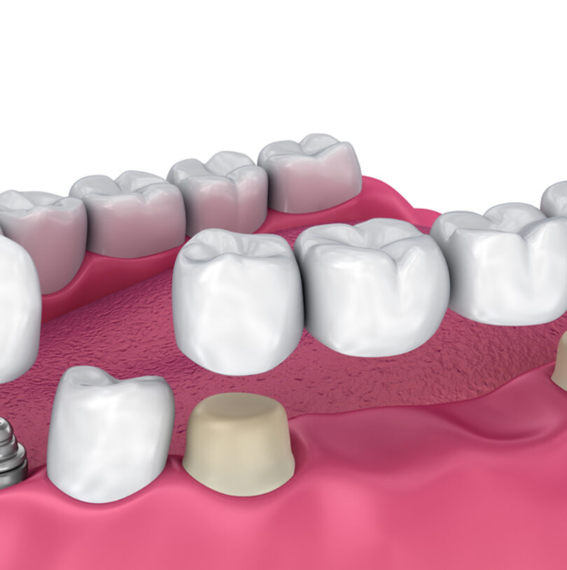 blog - Cheadle Hulme Dental