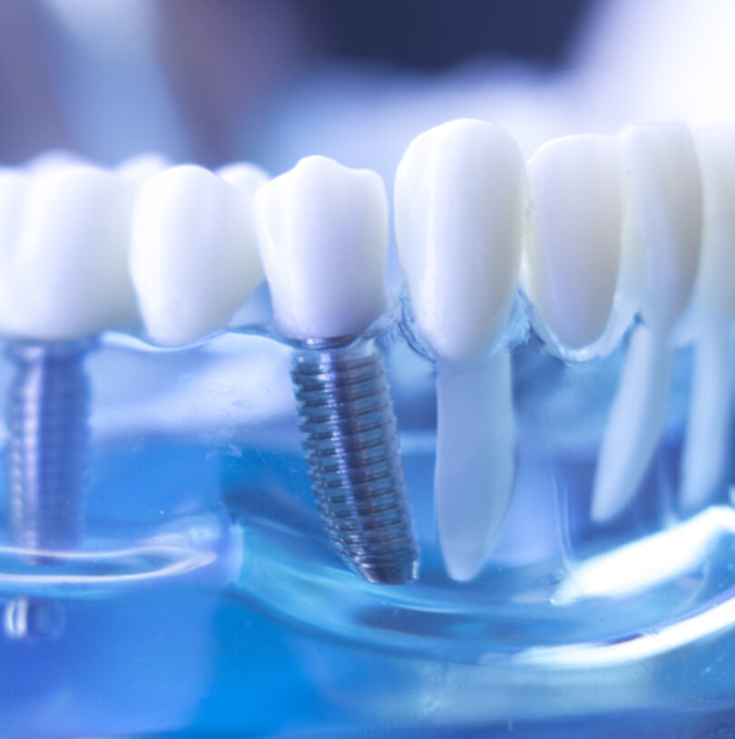 Dental Implants Mancheste