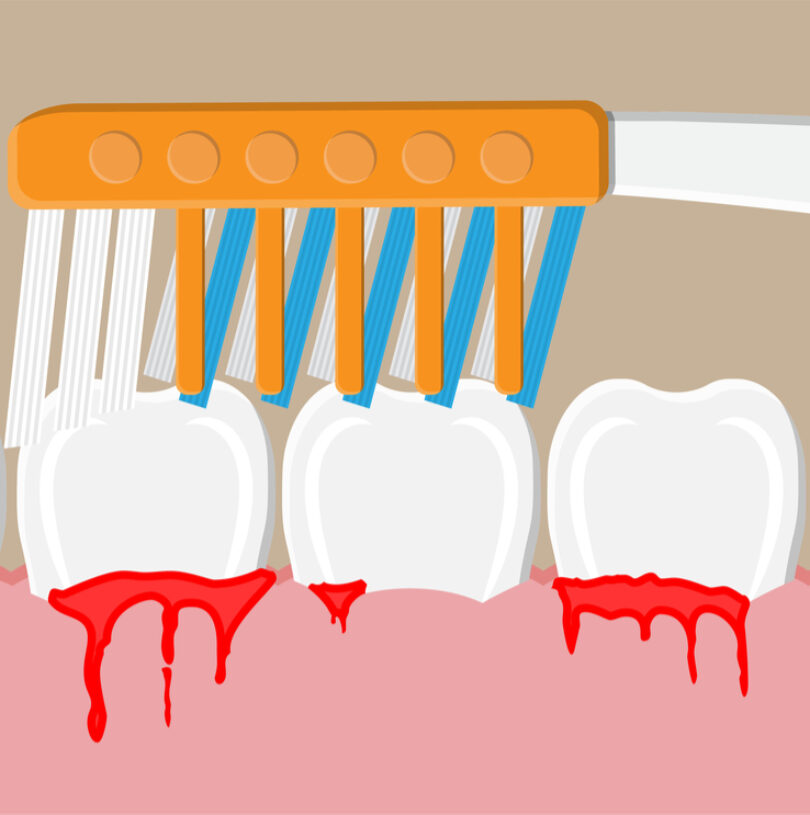 blog - Cheadle Hulme Dental