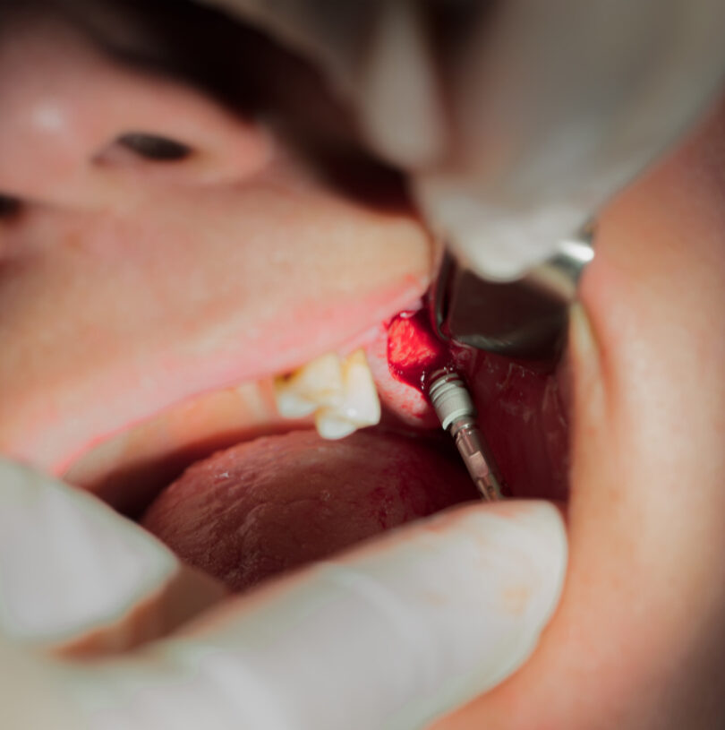 Dental Implants Didsbury