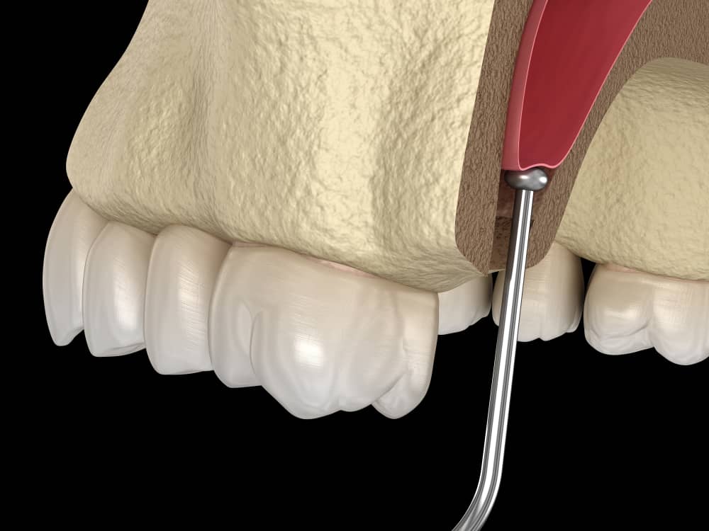 Sinus Lift - Cheadle Hulme