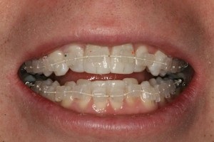 six-month-smile-south-manchester