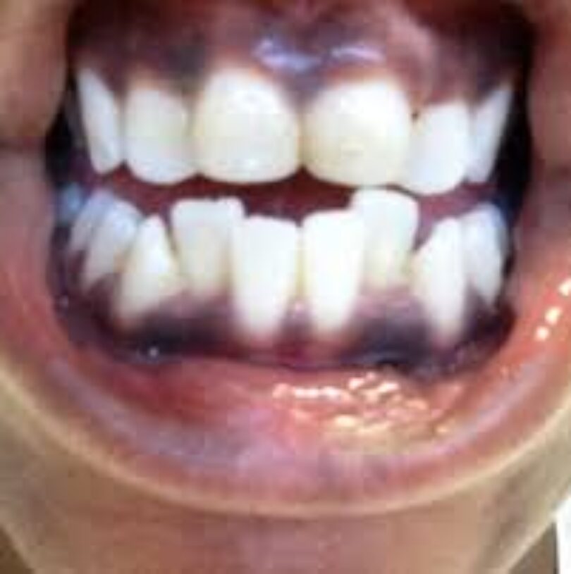 blog - Cheadle Hulme Dental