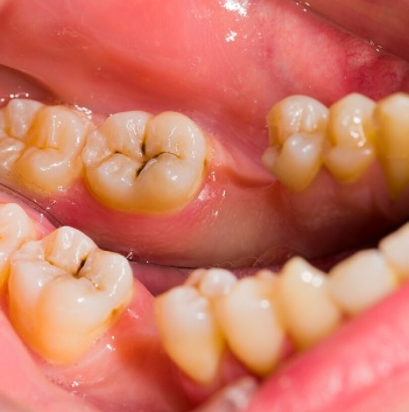 blog - Cheadle Hulme Dental