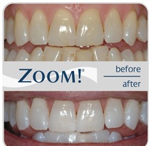 teeth-whitening-wilmslow