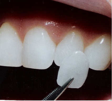 veneer2