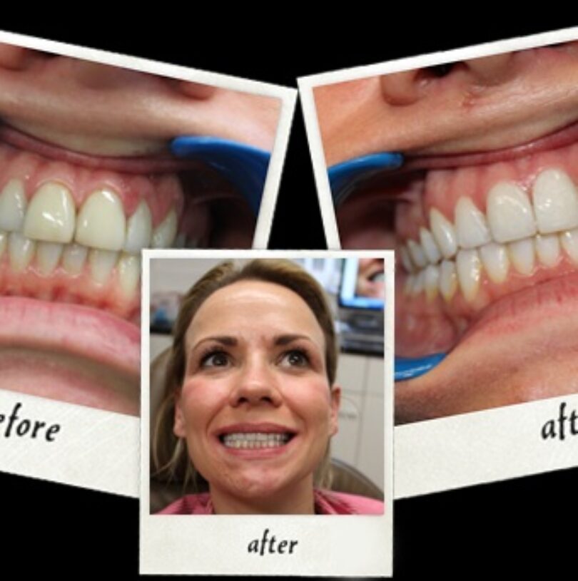 Porcelain Veneers at Church Road Dental Practice