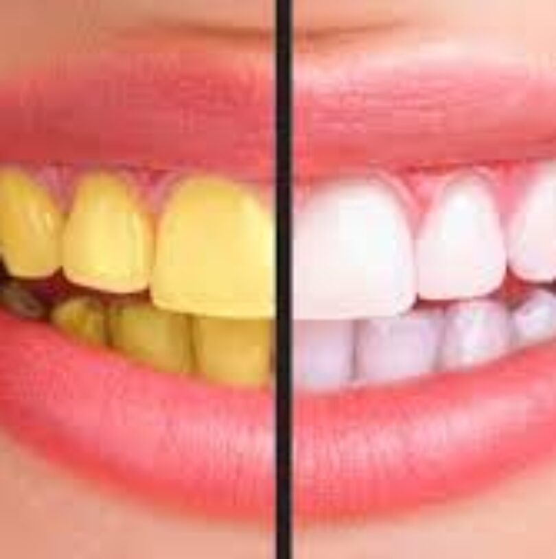 blog - Cheadle Hulme Dental