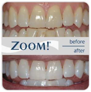 zoom-before-after (1)
