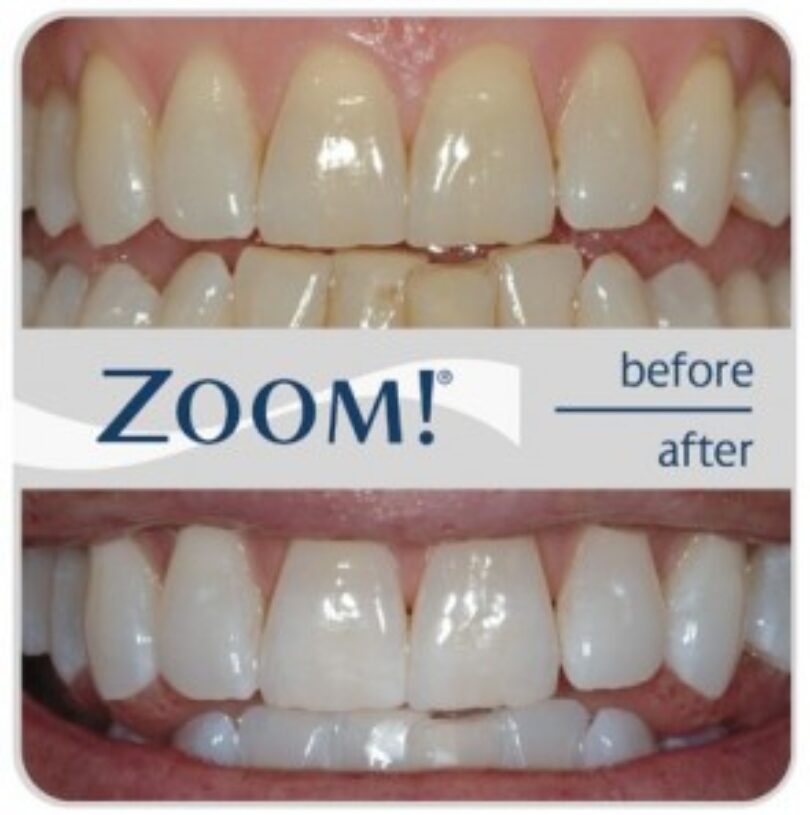 blog - Cheadle Hulme Dental