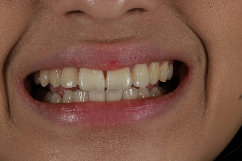 After - Cheadle Hulme Dental