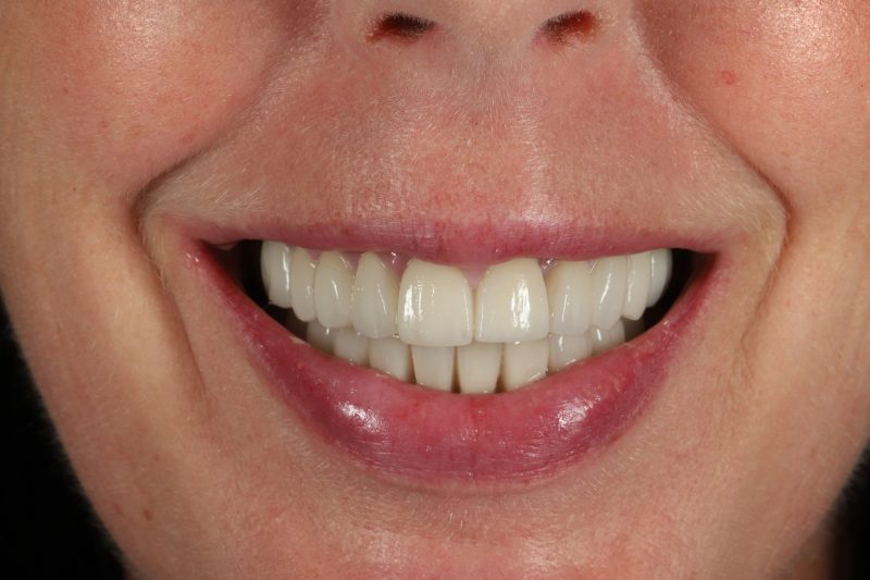 After - Cheadle Hulme Dental