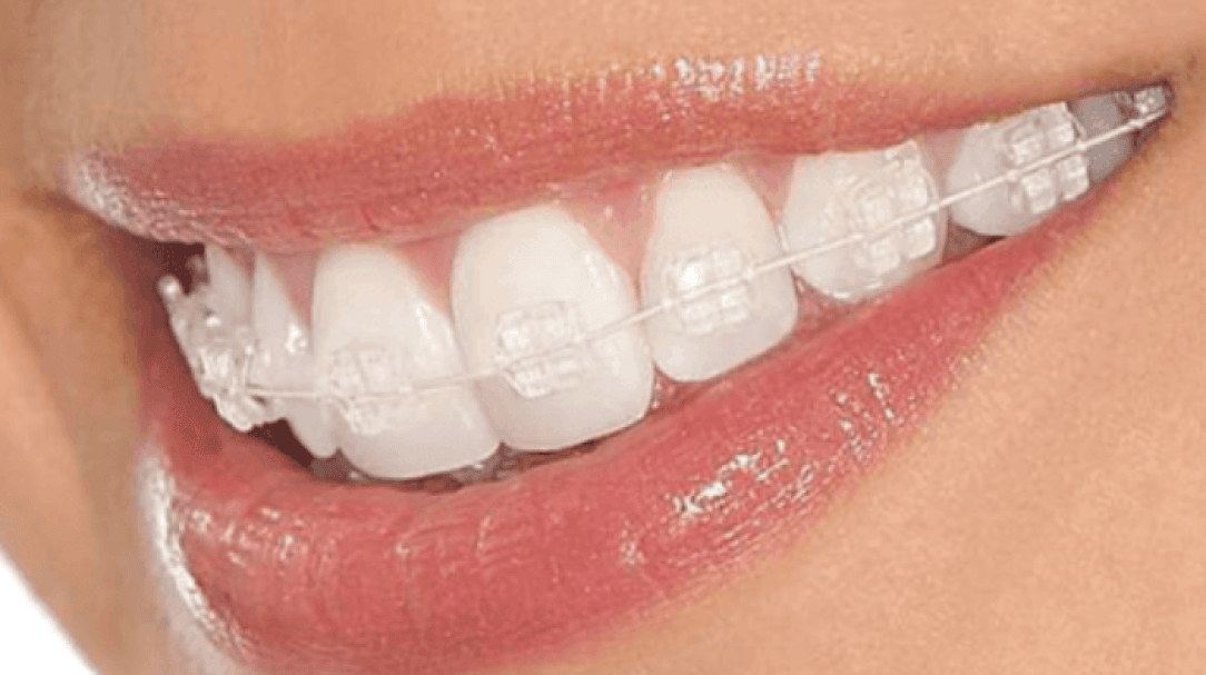 blog inner thumb : Cheadle Hulme Dental