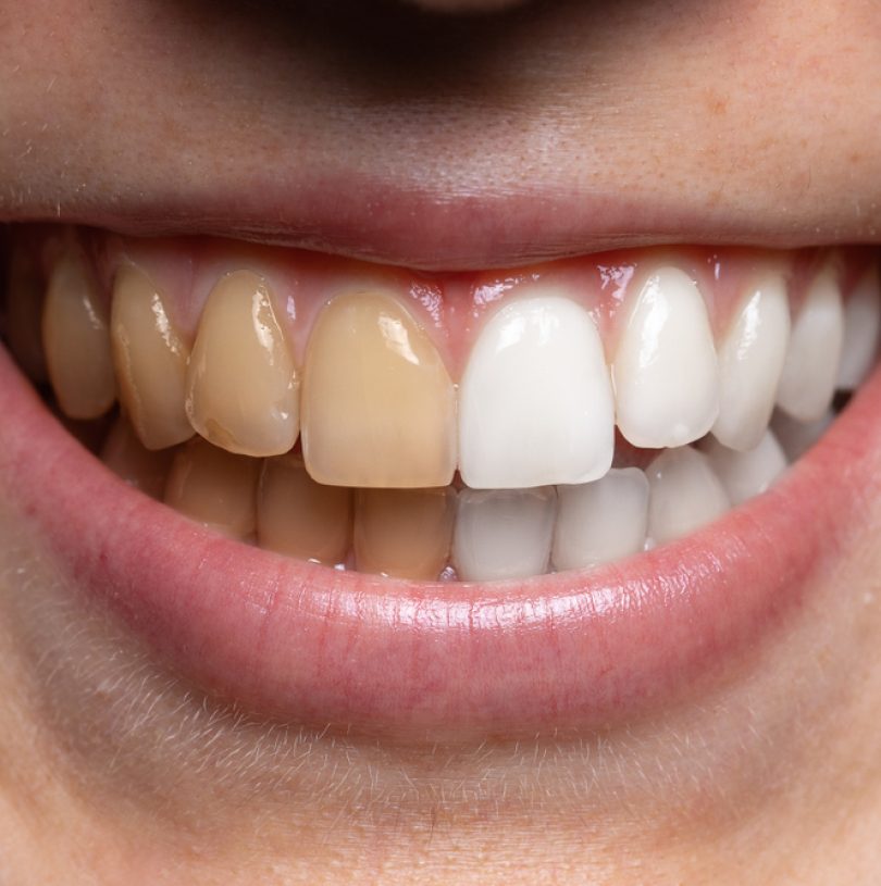 Achieve A Brighter Smile With Teeth Whitening At Church Road Dental Practice