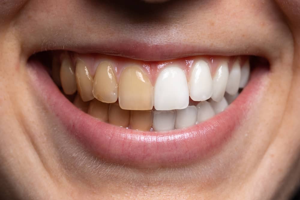 Achieve A Brighter Smile With Teeth Whitening At Church Road Dental Practice