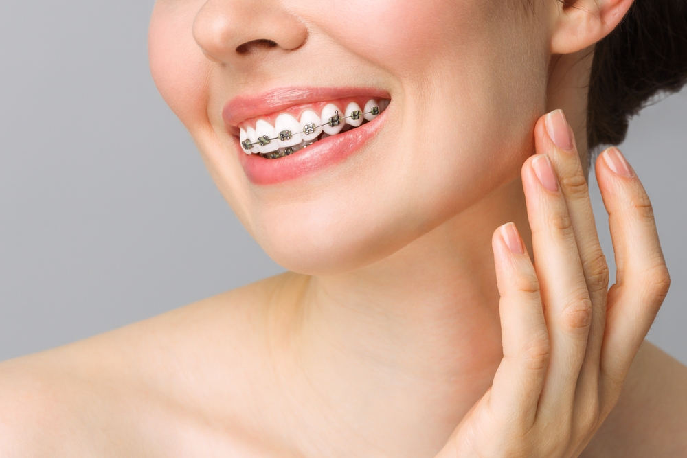 Braces Offers