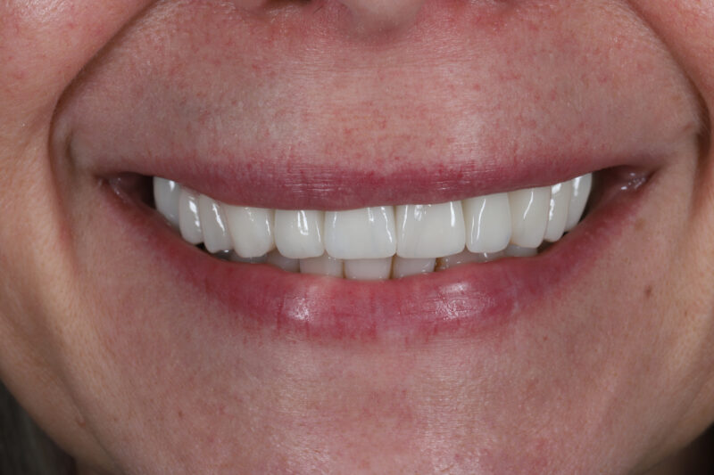 After - Cheadle Hulme Dental