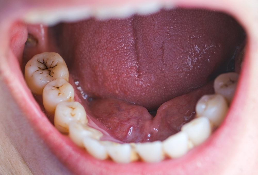 What Does A Decaying Tooth Look Like Detroit Chinatown What Does A Decaying Tooth Look Like Detroit Chinatown
