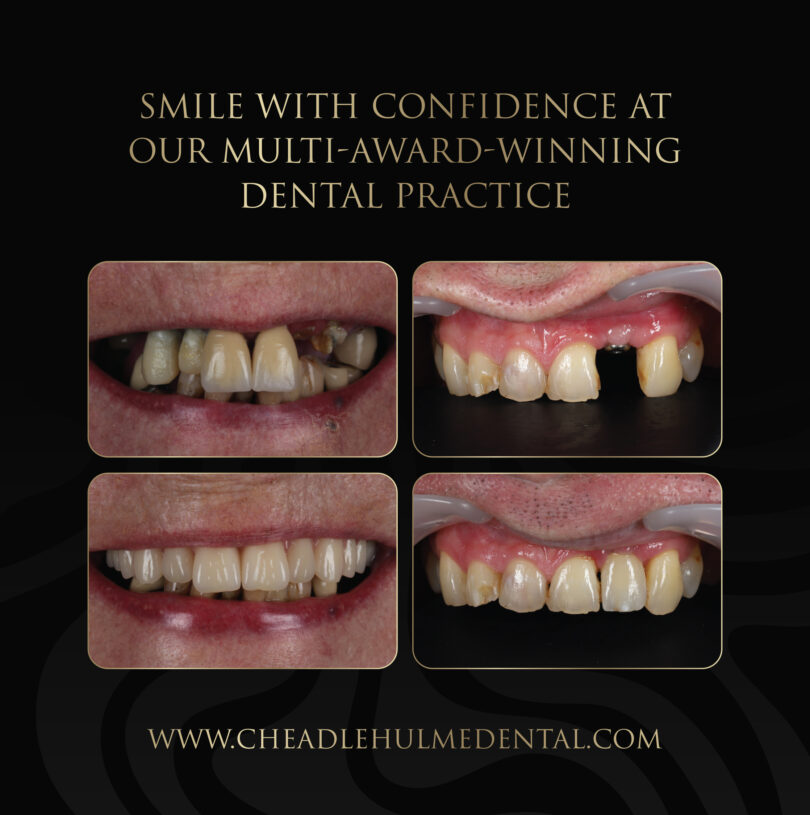 dental implants offer