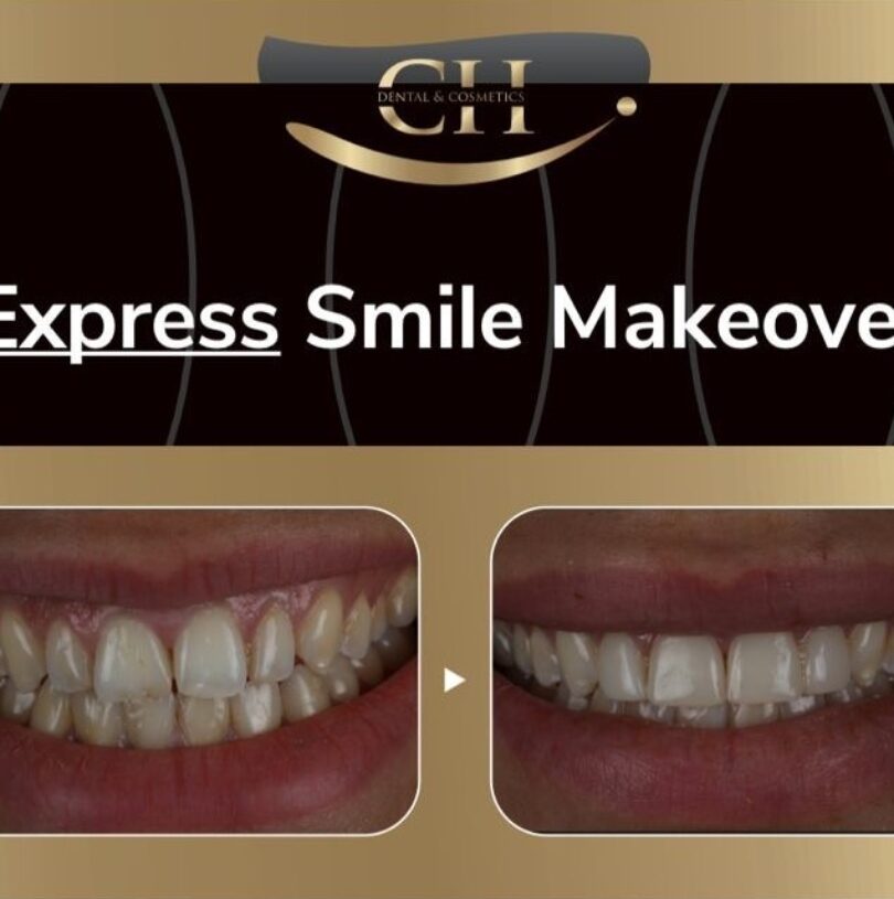 Composite bonding express smile makeover