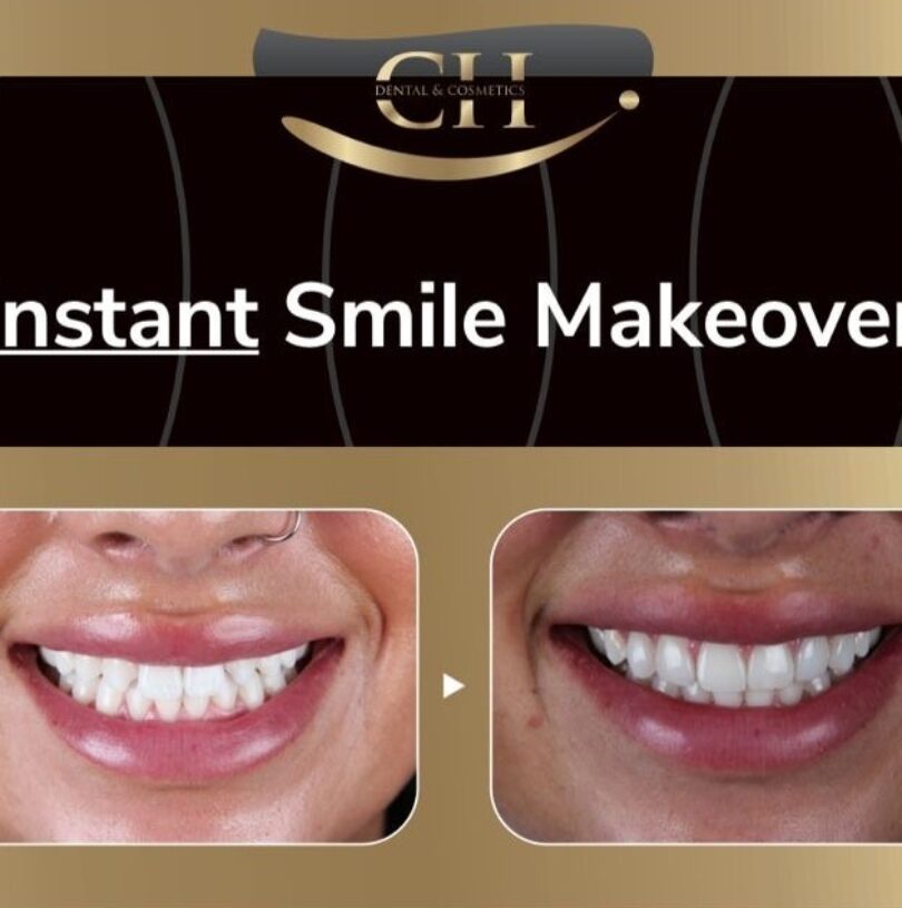 Composite veneers treatment package