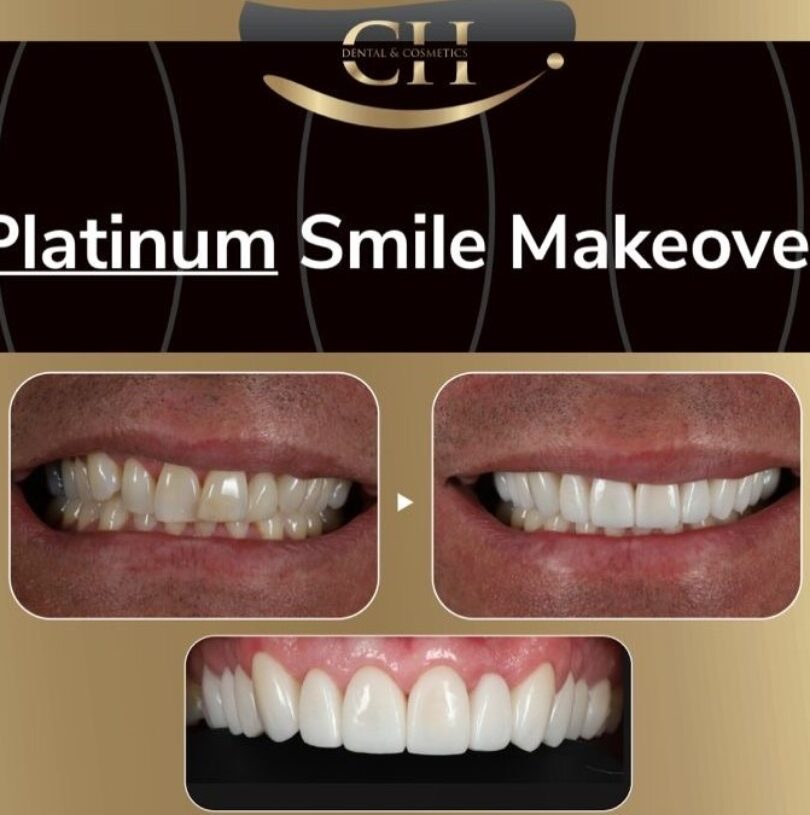 porcelain veneers treatment package